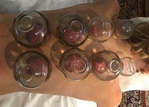 wellnessmassage Hotstonemassage Cupping