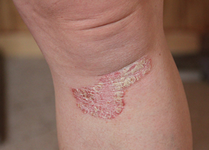 Doktorfisk spiser Psoriasis